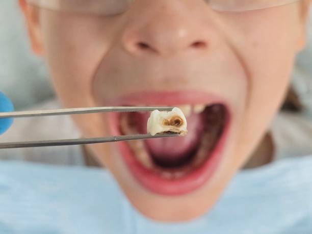 Best Emergency Dental Care for Broken or Chipped Teeth in Clarksville, TN