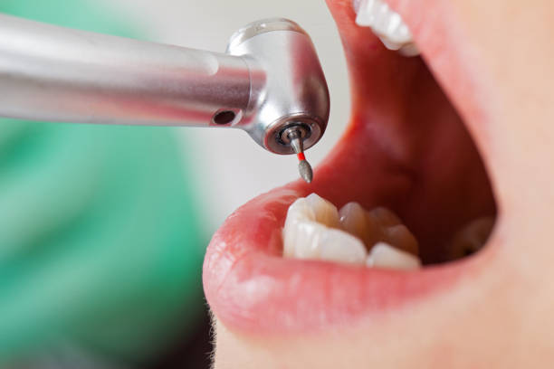 Best Emergency Treatment for Dental Infections or Abscesses in Clarksville, TN